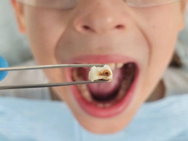 Best Chipped Tooth Repair Near Me  in Ara, AL